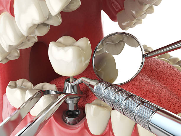 Best Emergency Treatment for Dental Infections or Abscesses in Novi, MI